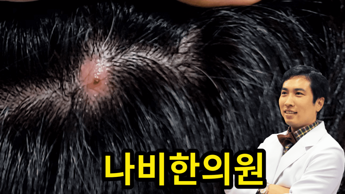 두피 모낭염