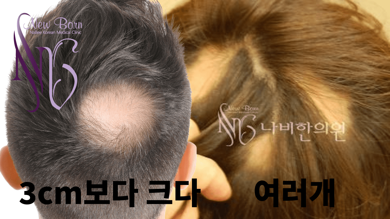 원형탈모 치료의 최신동향