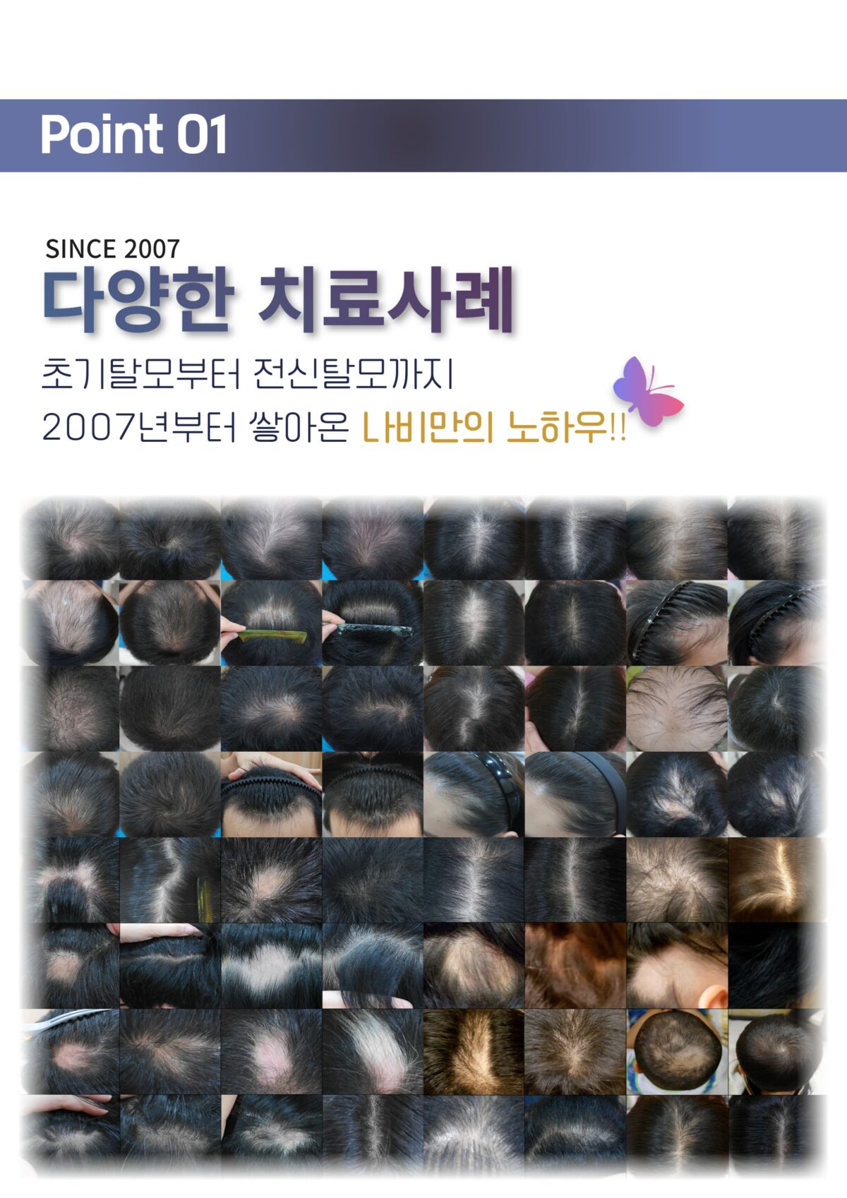 여성형탈모약