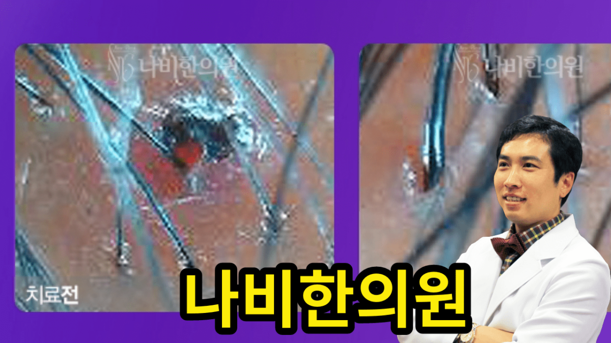 두피 모낭염