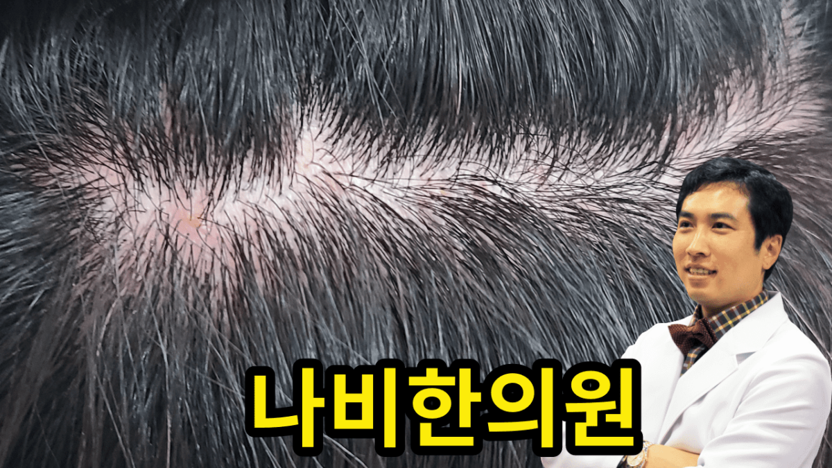 두피 모낭염