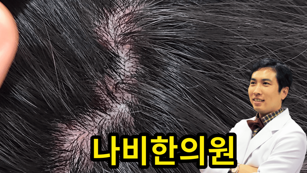 두피 모낭염