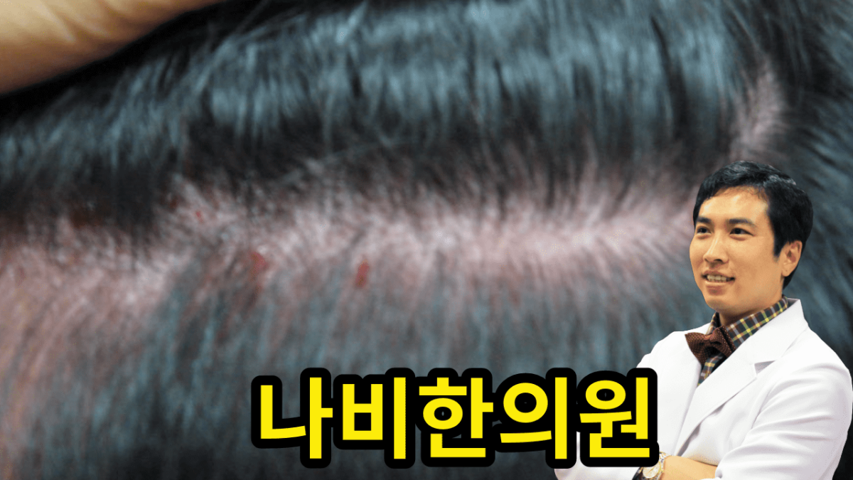 두피 모낭염