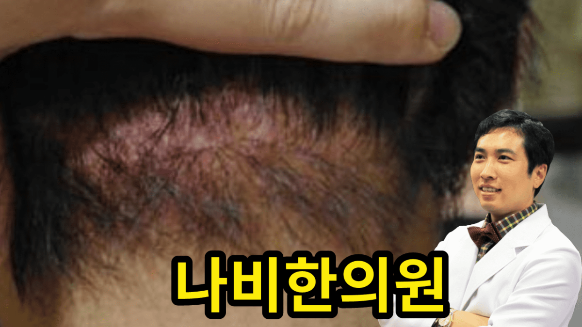 두피 모낭염