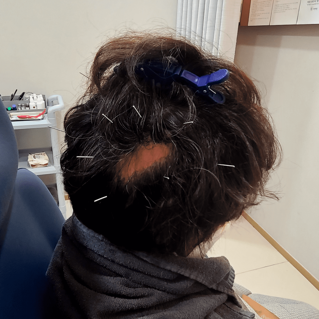 원형탈모치료