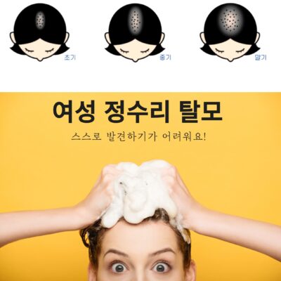 탈모약