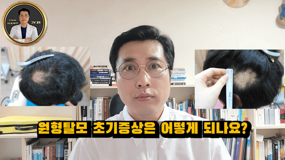 원형탈모