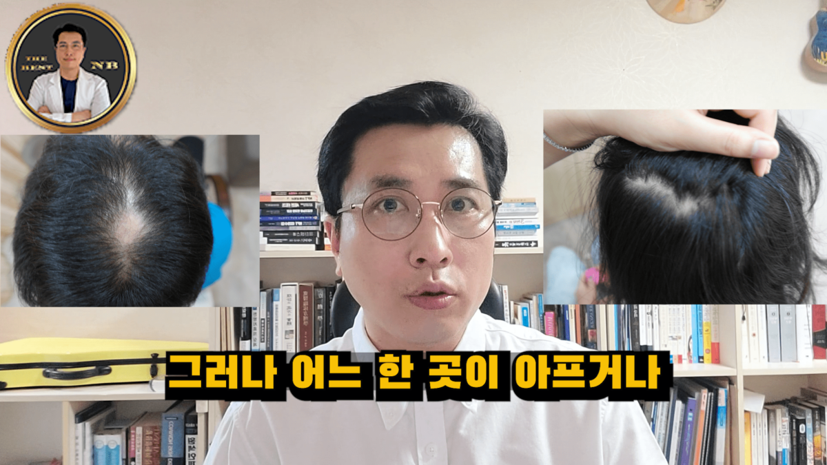 원형탈모