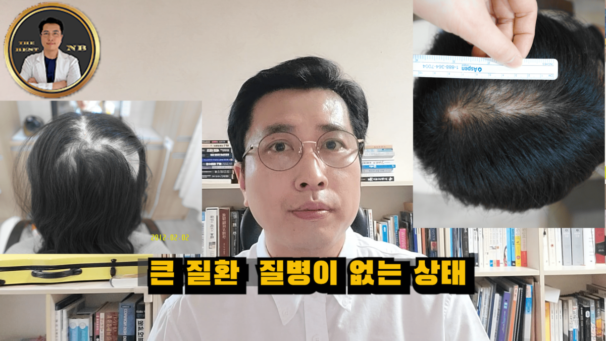 원형탈모