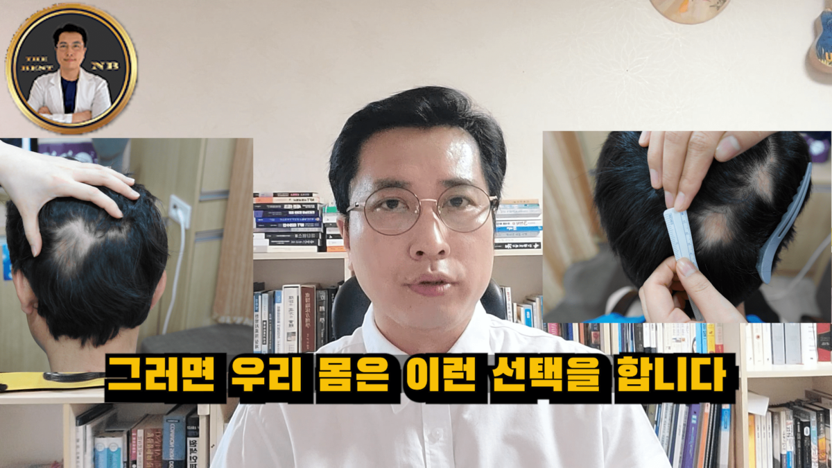 원형탈모
