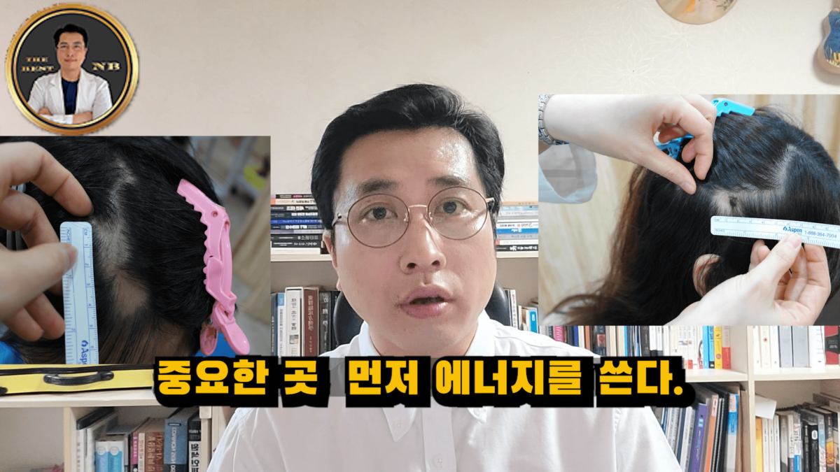 원형탈모