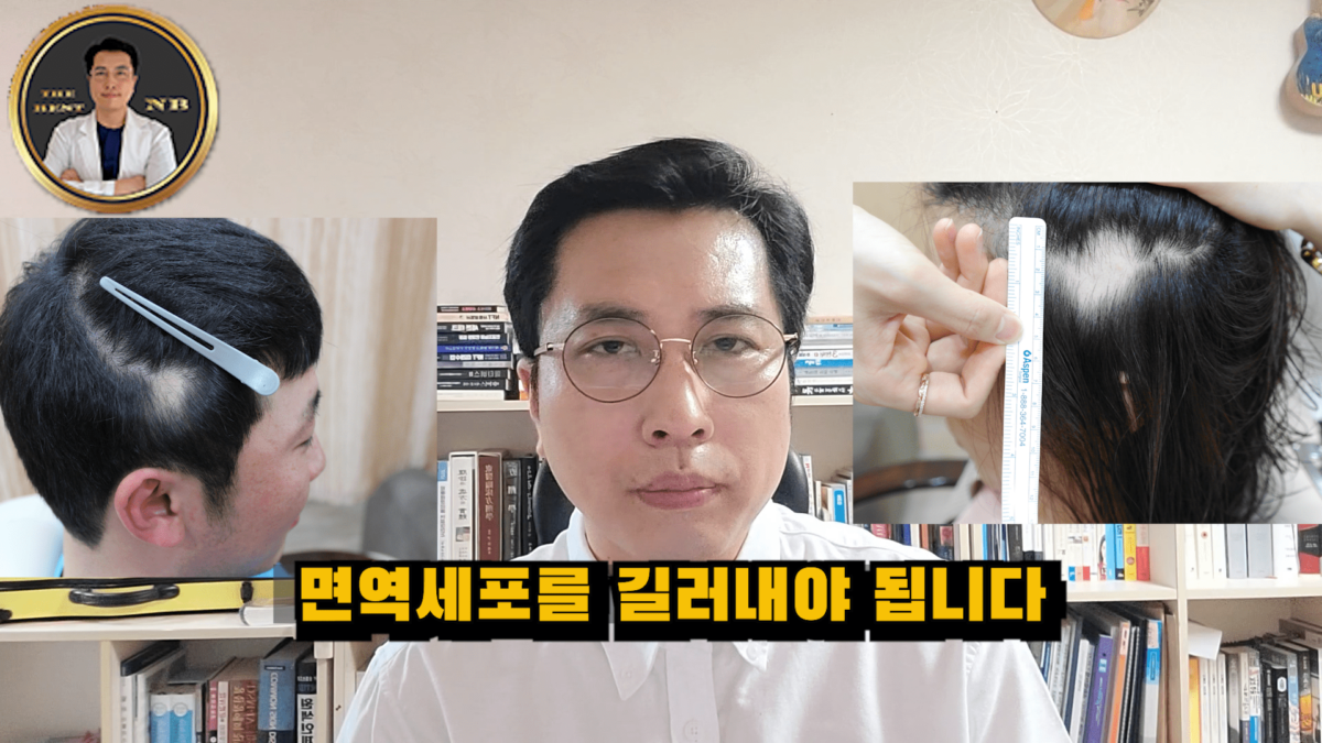 원형탈모