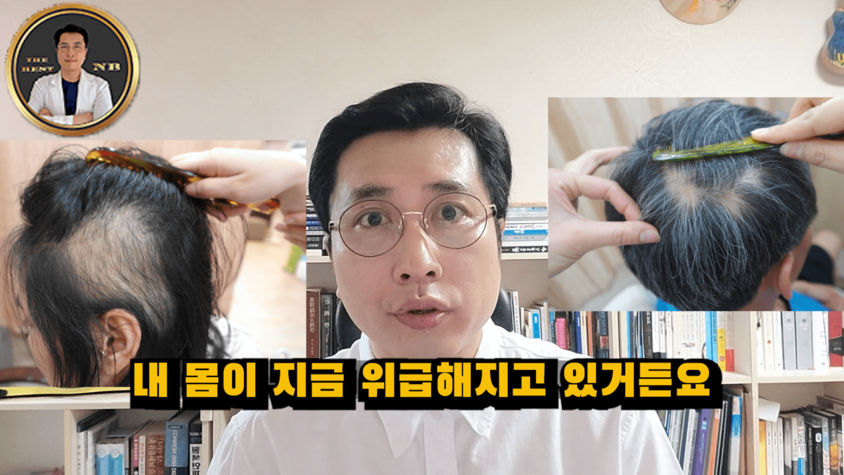 원형탈모