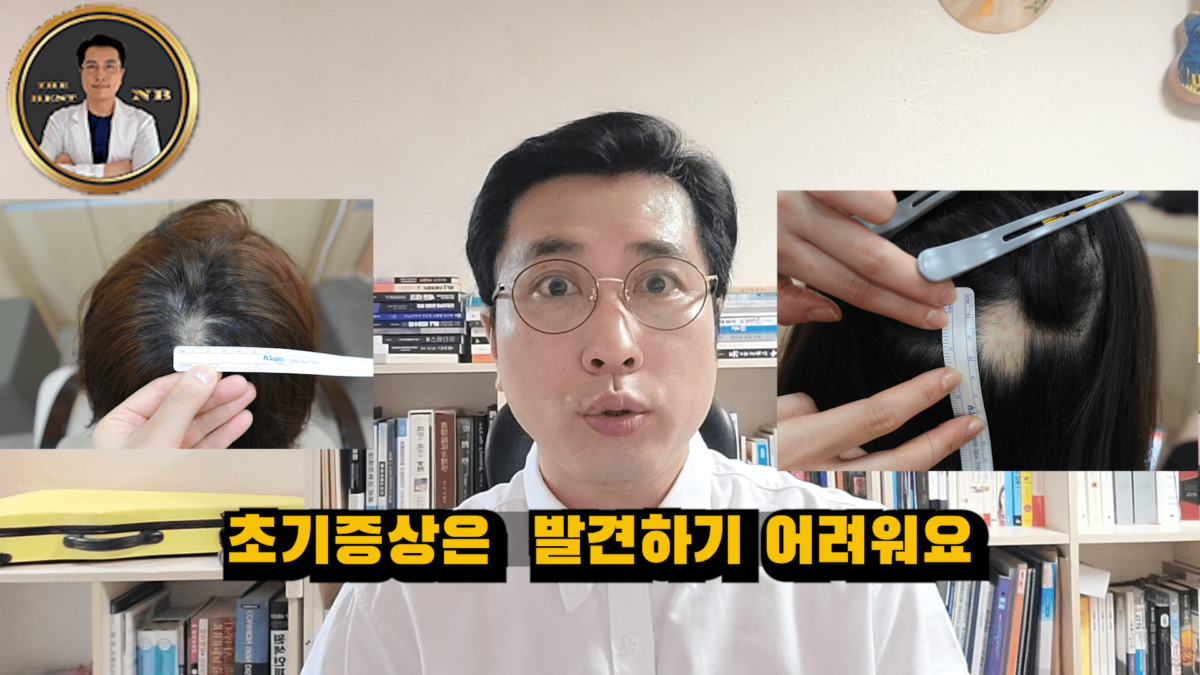 원형탈모