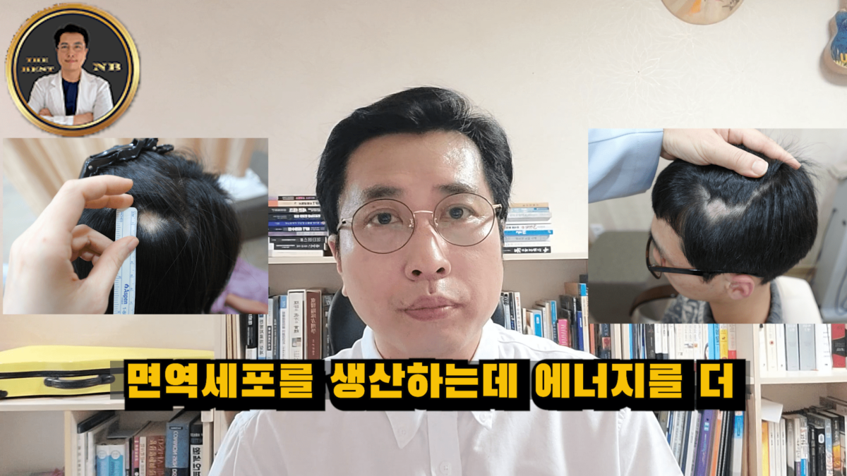 원형탈모
