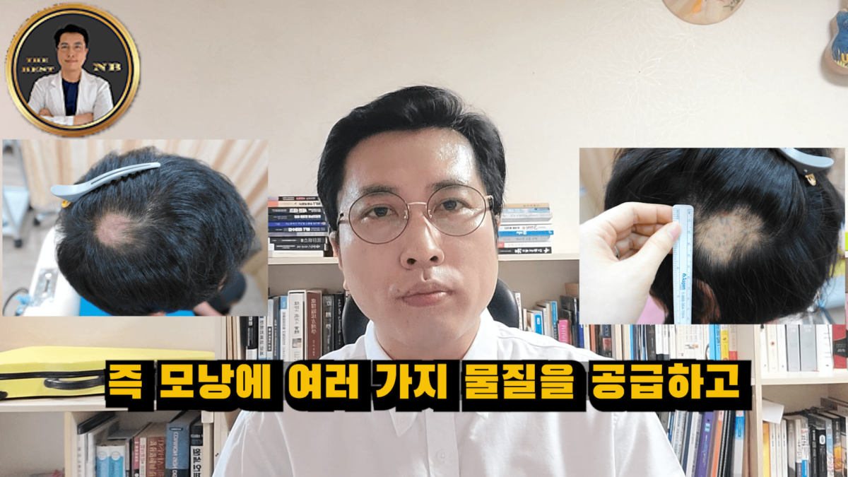 원형탈모