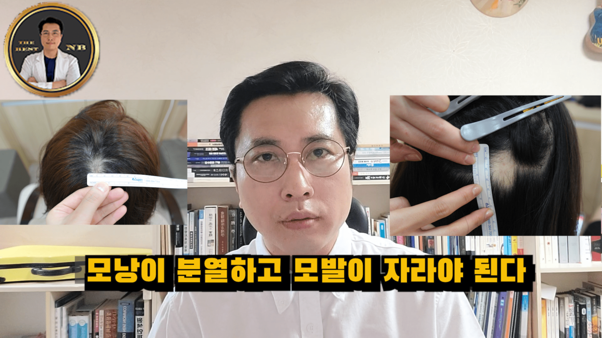 원형탈모