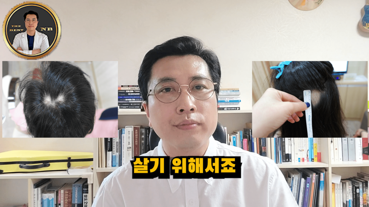 원형탈모