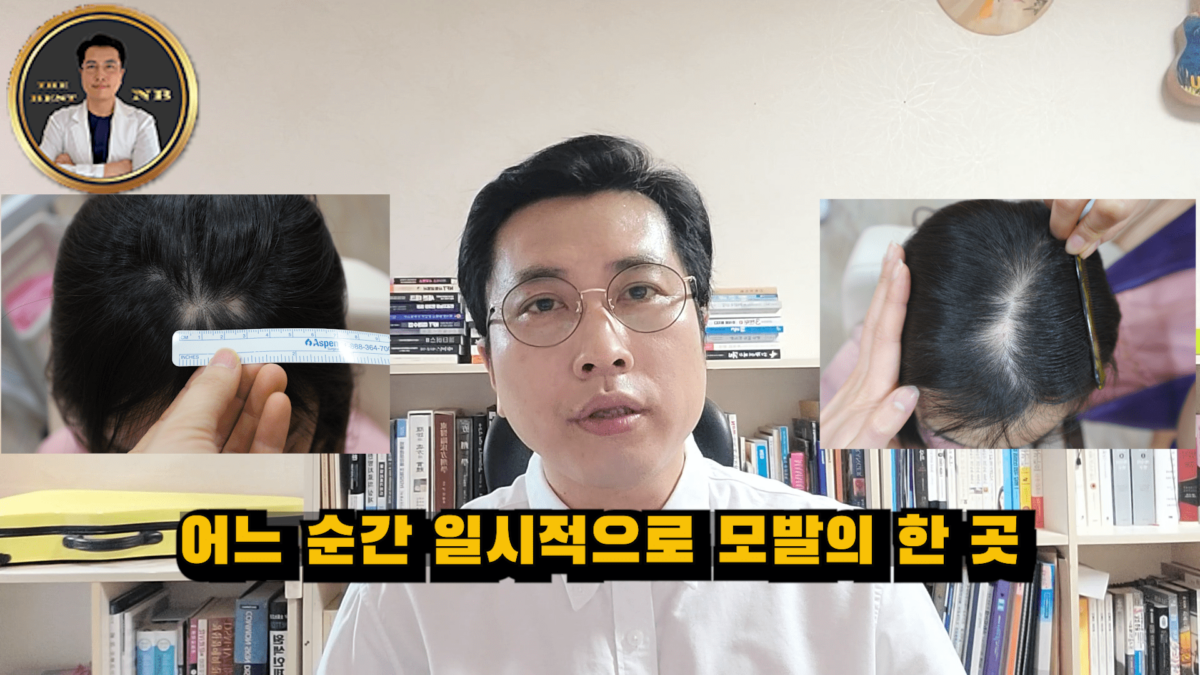 원형탈모