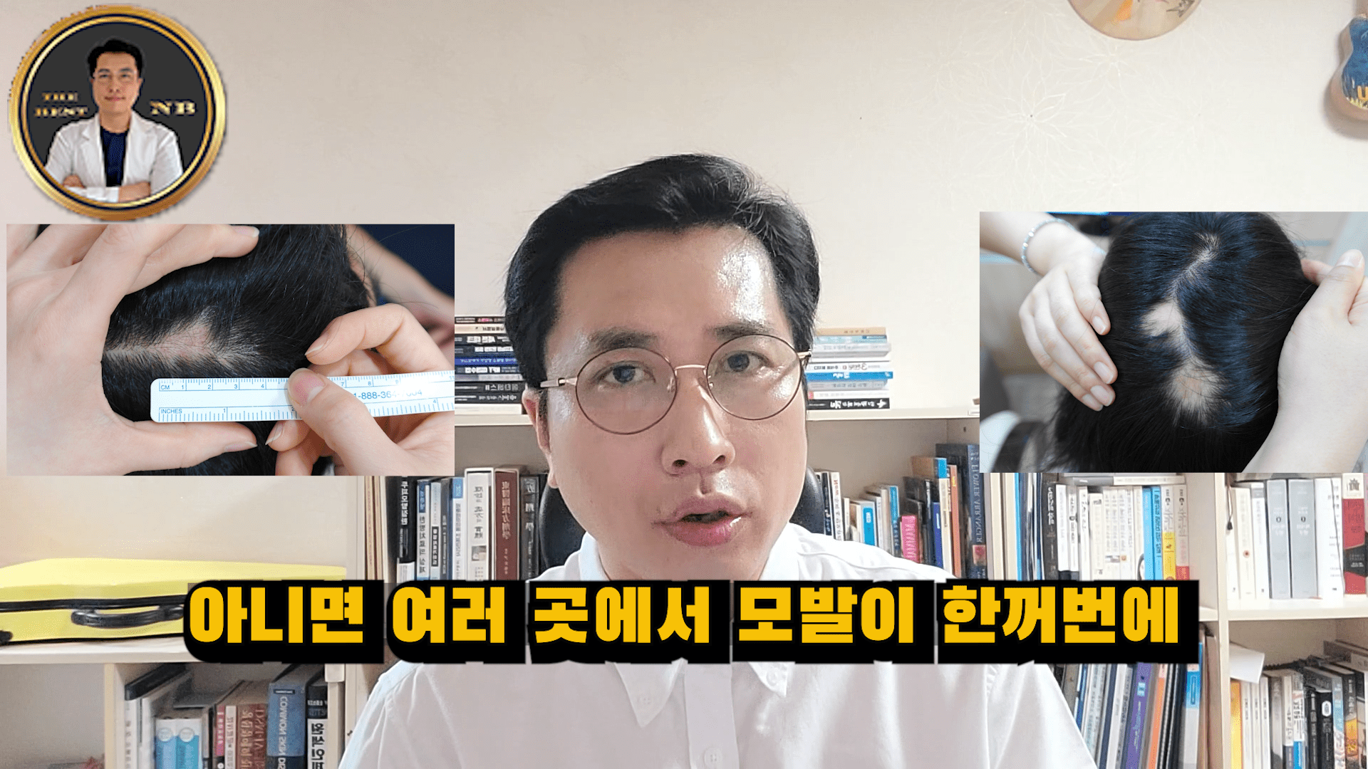 원형탈모