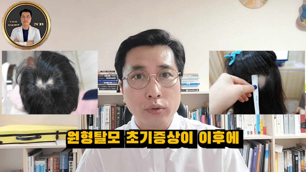 원형탈모