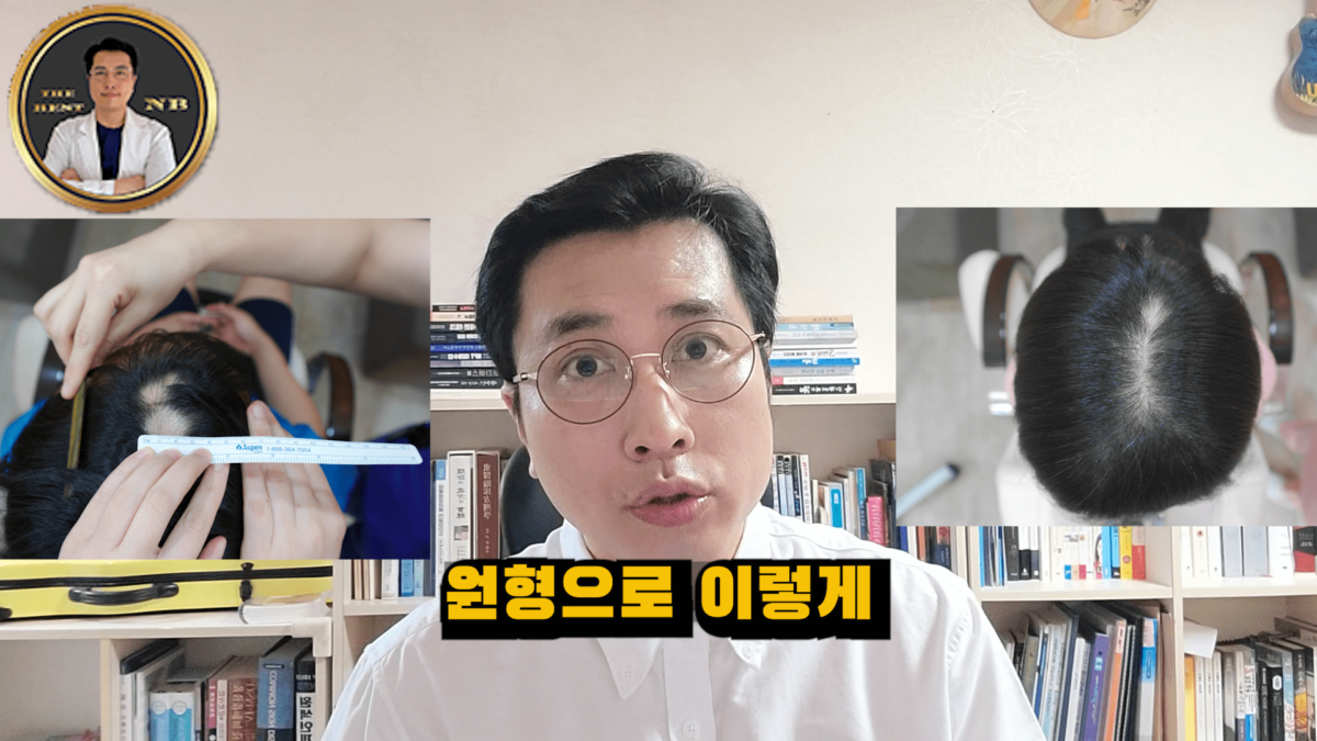 원형탈모