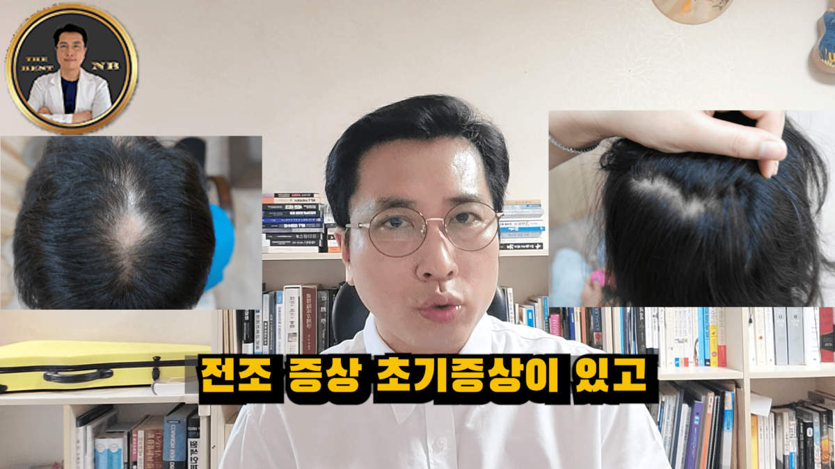 원형탈모