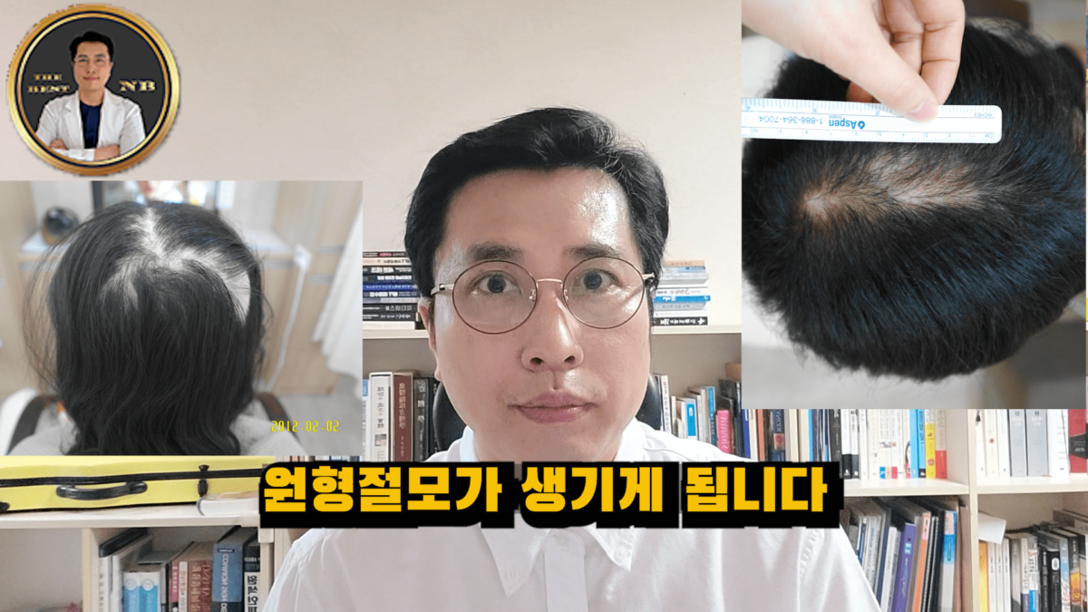 원형탈모