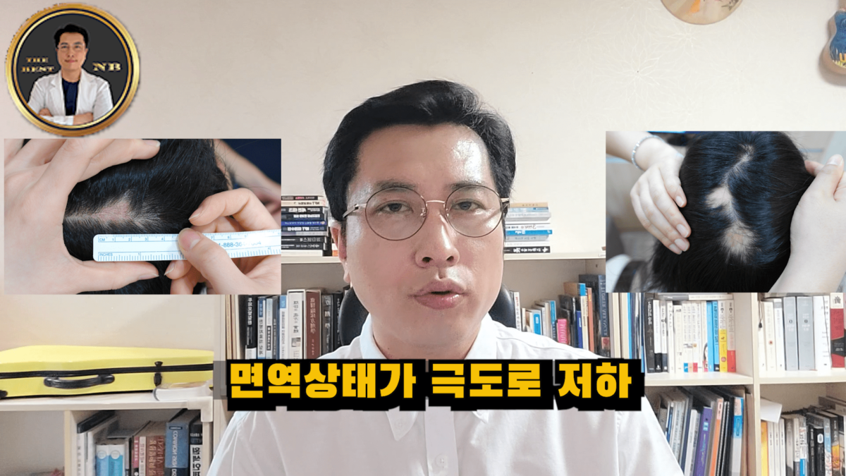 원형탈모