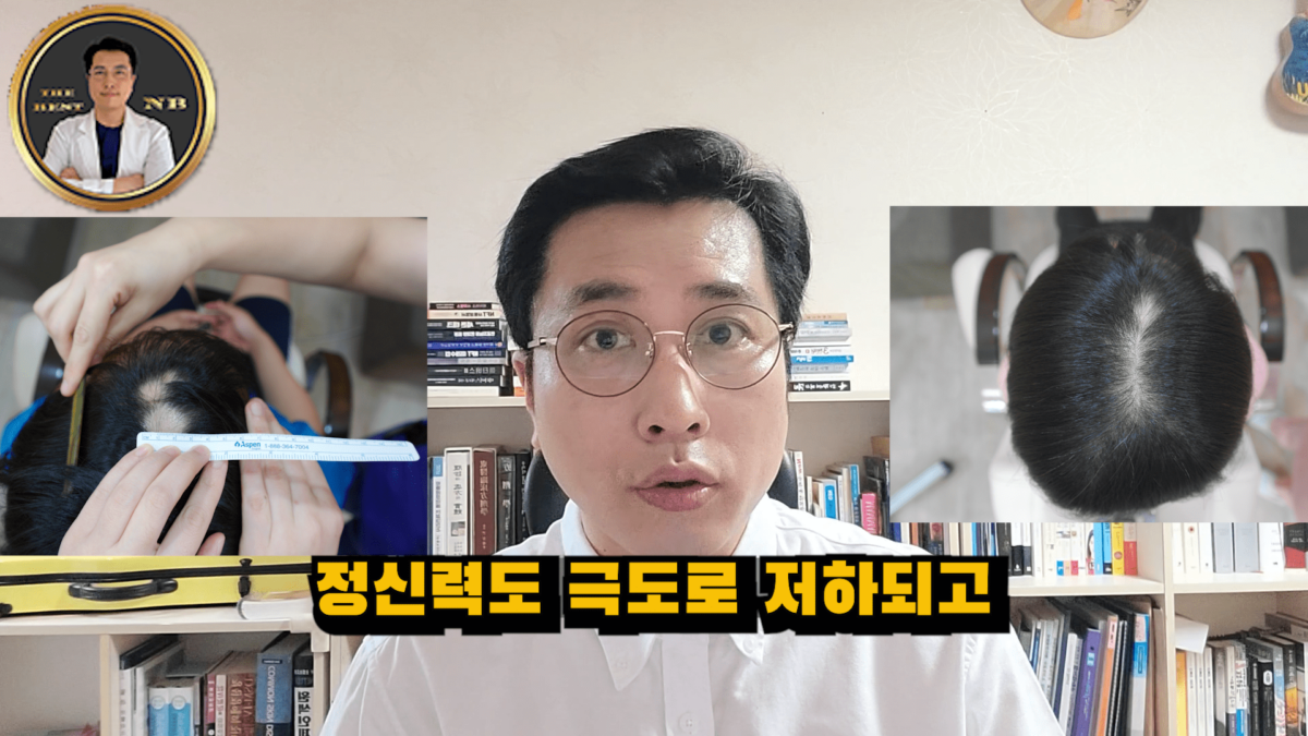 원형탈모