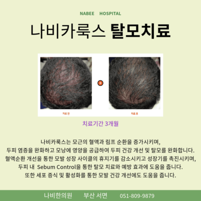 탈모갤